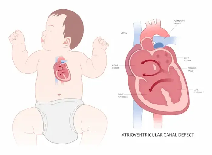 What Is Acyanotic Congenital Heart Disease?